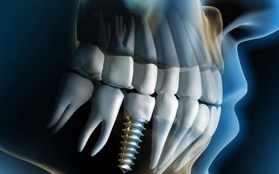 Primarna stabilnost implantata: što znači, kako se mjeri i zašto određuje kada se stavlja krunica