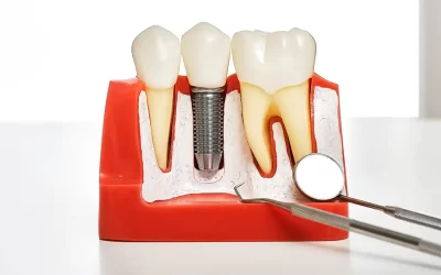 Zubni implantati: kompletan vremenski tijek od planiranja do krunice