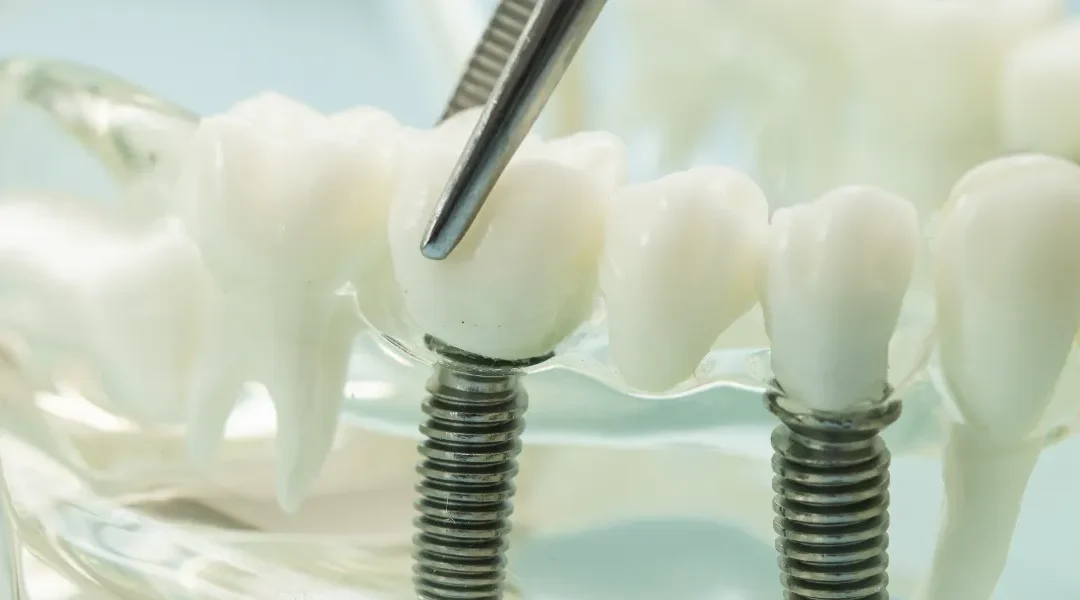 Zubni implantat vs. most: kada je implantat dugoročno bolje rješenje?