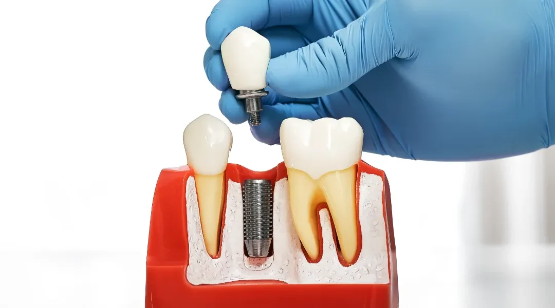 5 razloga zašto su implantati dugoročno pouzdaniji od mobilnih proteza