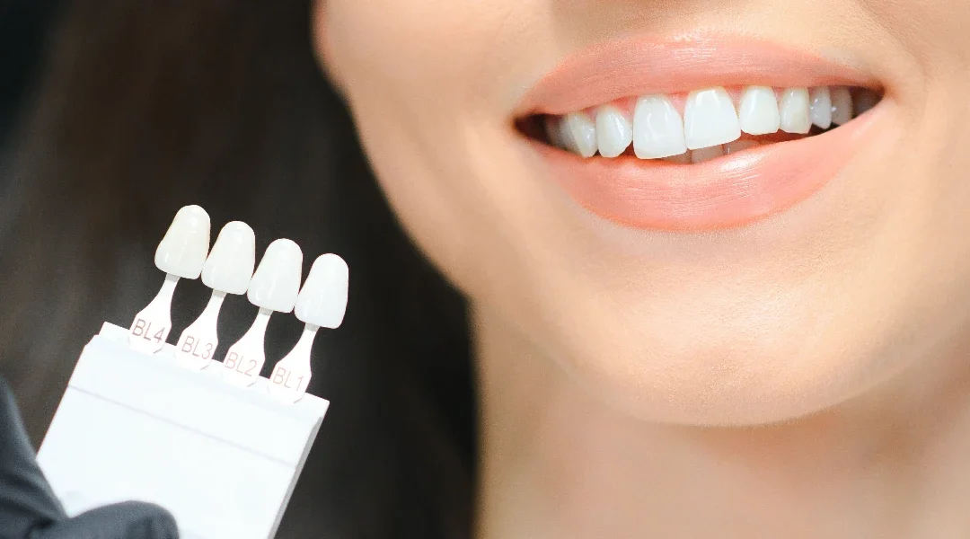 Zubne ljuskice: trajnost, održavanje i najčešće greške u odabiru indikacije