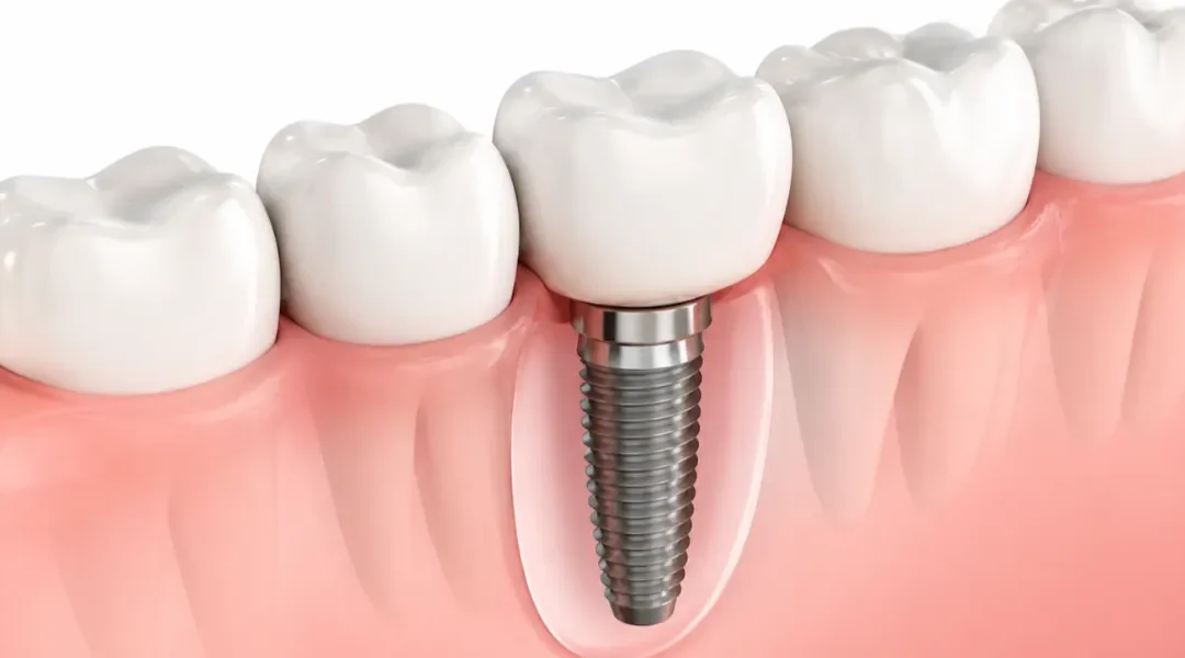 Sinus lift i implantati: interni vs. eksterni pristup – indikacije i oporavak