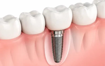 Sinus lift i implantati: interni vs. eksterni pristup – indikacije i oporavak
