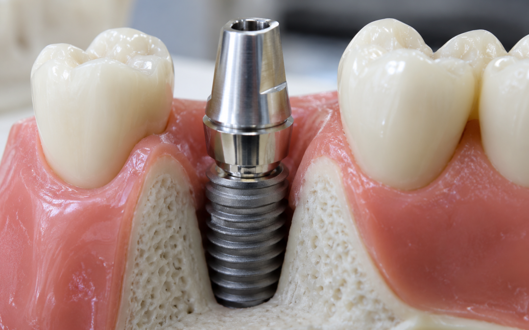 Spoj suprastrukture i implantata: zašto mikropukotina, otpuštanje vijka i preciznost dosjeda utječu na trajnost implantata